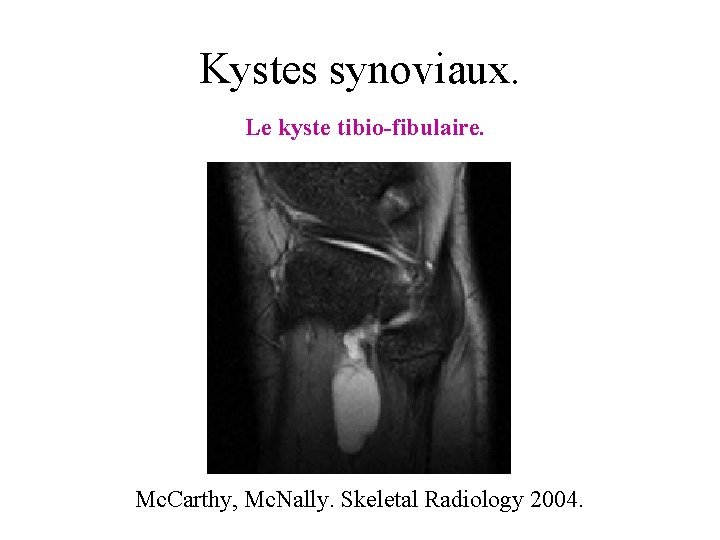 Kystes synoviaux. Le kyste tibio-fibulaire. Mc. Carthy, Mc. Nally. Skeletal Radiology 2004. 