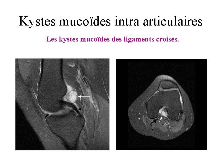 Kystes mucoïdes intra articulaires Les kystes mucoïdes ligaments croisés. 