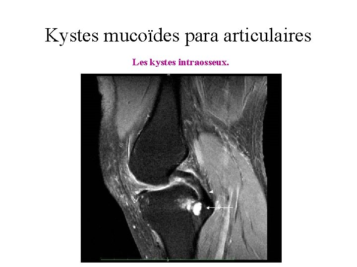 Kystes mucoïdes para articulaires Les kystes intraosseux. 