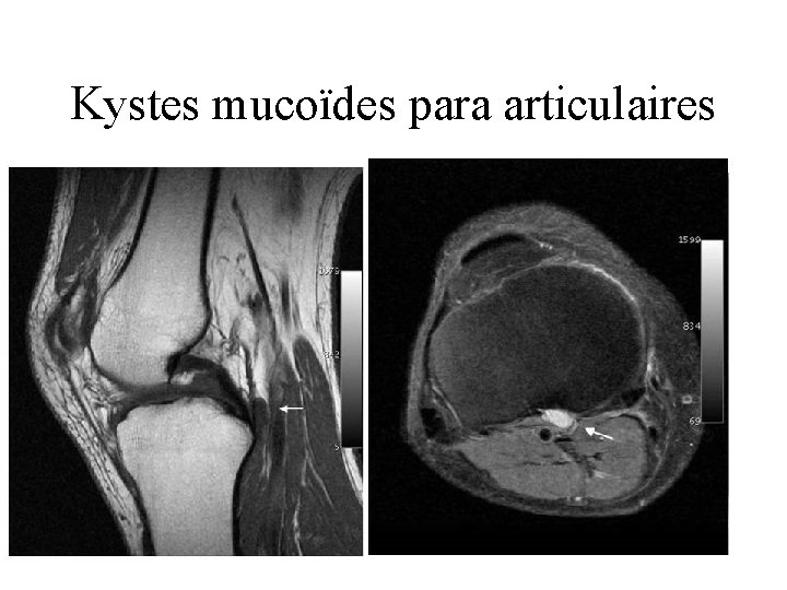 Kystes mucoïdes para articulaires 
