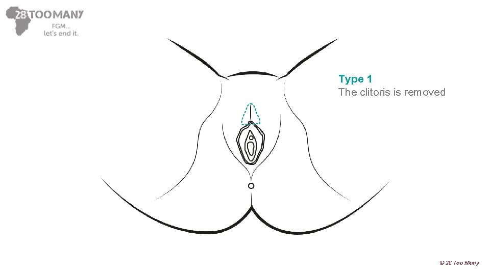 Type 1 The clitoris is removed © 28 Too Many 