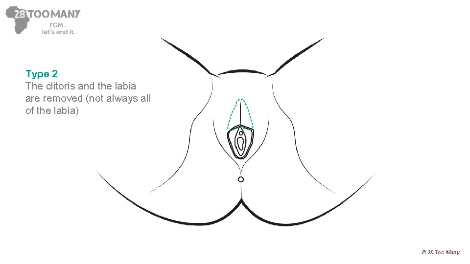 Type 2 The clitoris and the labia are removed (not always all of the