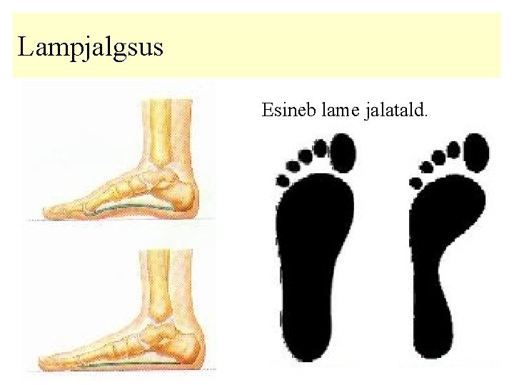 Lampjalgsus Esineb lame jalatald. 