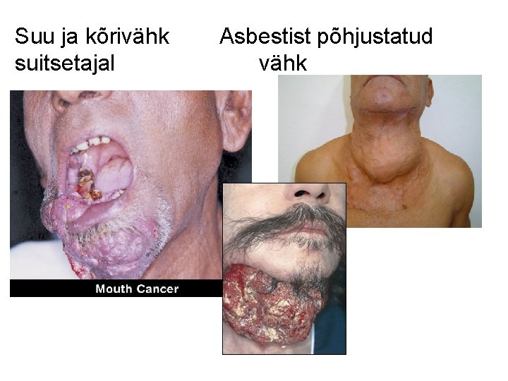 Suu ja kõrivähk Asbestist põhjustatud suitsetajal vähk 