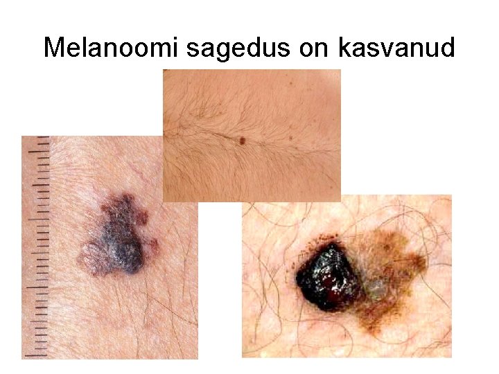 Melanoomi sagedus on kasvanud 