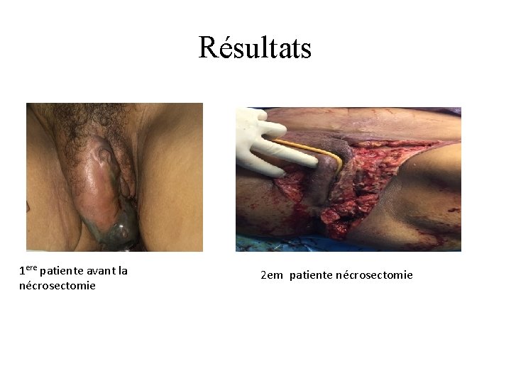 Résultats 1 ere patiente avant la nécrosectomie 2 em patiente nécrosectomie 
