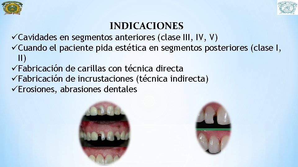 INDICACIONES üCavidades en segmentos anteriores (clase III, IV, V) üCuando el paciente pida estética