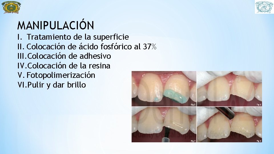 MANIPULACIÓN I. Tratamiento de la superficie II. Colocación de ácido fosfórico al 37% III.