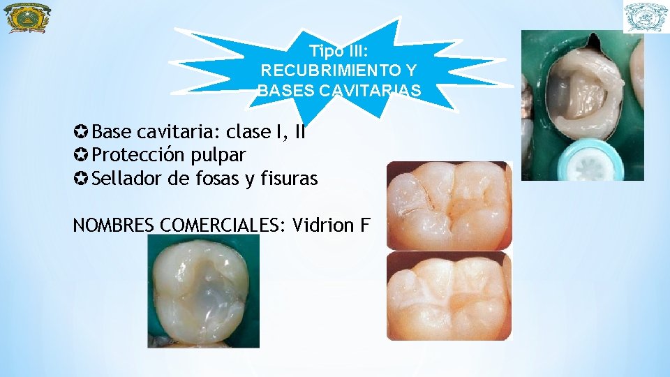 Tipo III: RECUBRIMIENTO Y BASES CAVITARIAS Base cavitaria: clase I, II Protección pulpar Sellador