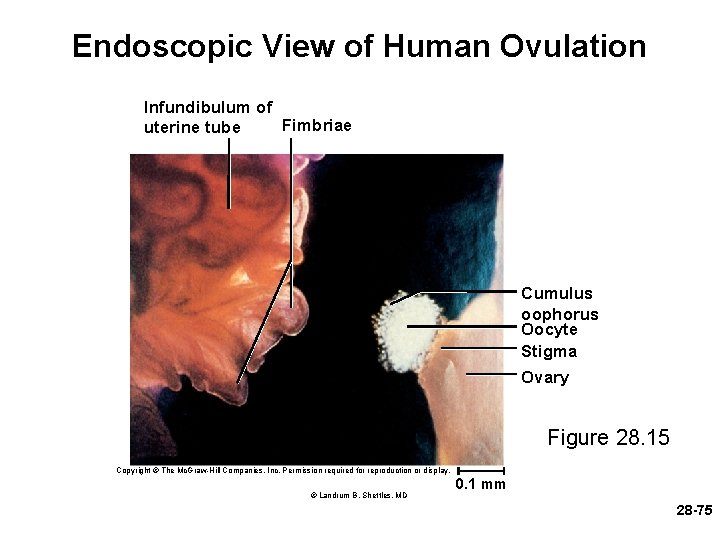 Endoscopic View of Human Ovulation Infundibulum of Fimbriae uterine tube Cumulus oophorus Oocyte Stigma