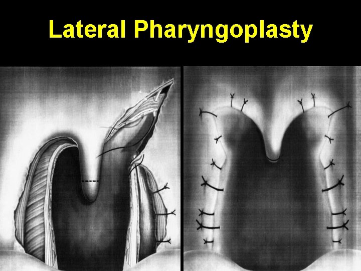 Lateral Pharyngoplasty 
