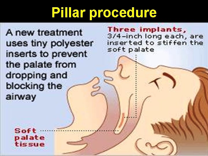 Pillar procedure 