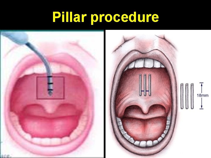 Pillar procedure 