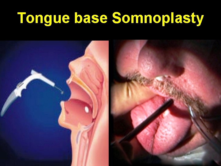 Tongue base Somnoplasty 