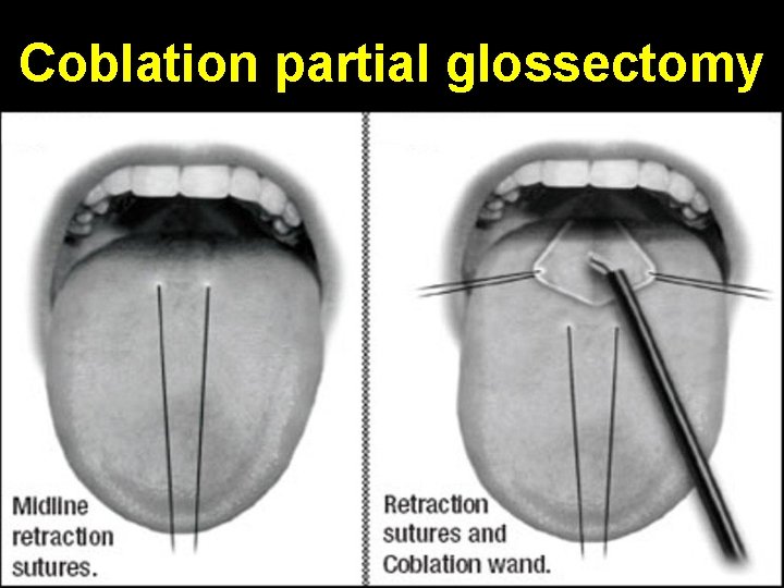 Coblation partial glossectomy 