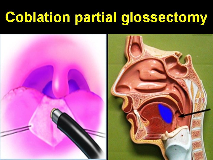 Coblation partial glossectomy 