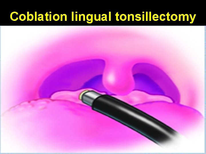 Coblation lingual tonsillectomy 