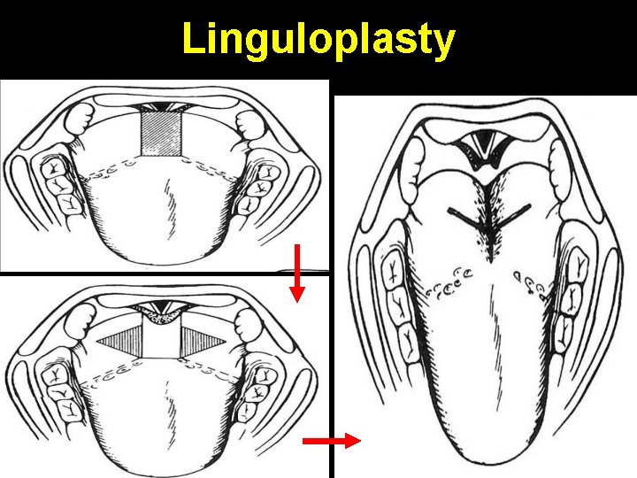 Linguloplasty 