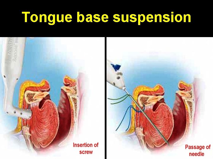 Tongue base suspension 