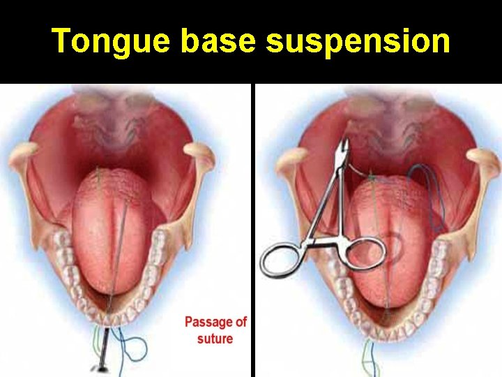 Tongue base suspension 