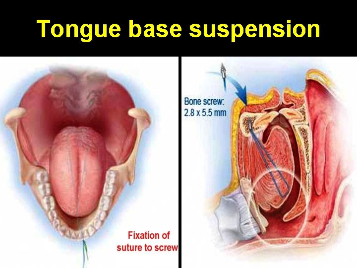 Tongue base suspension 