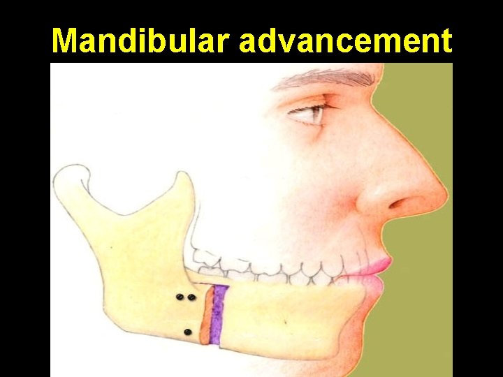 Mandibular advancement 