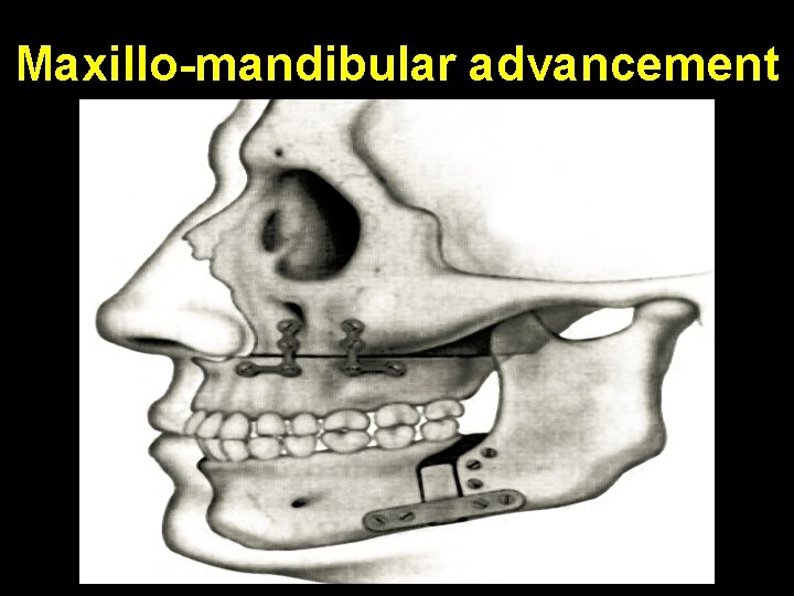 Maxillo-mandibular advancement 