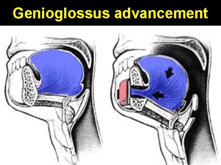 Genioglossus advancement 