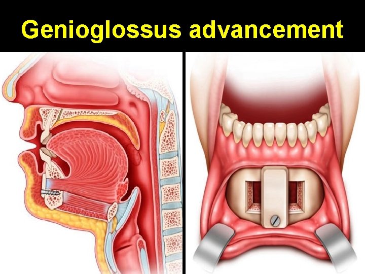 Genioglossus advancement 