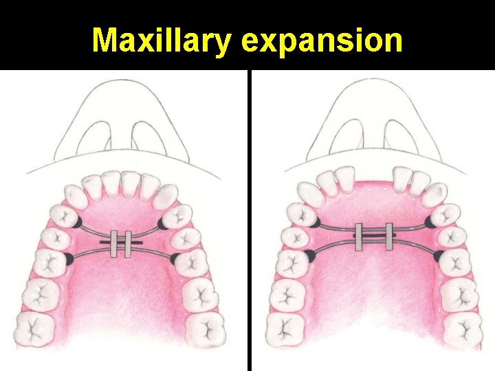 Maxillary expansion 