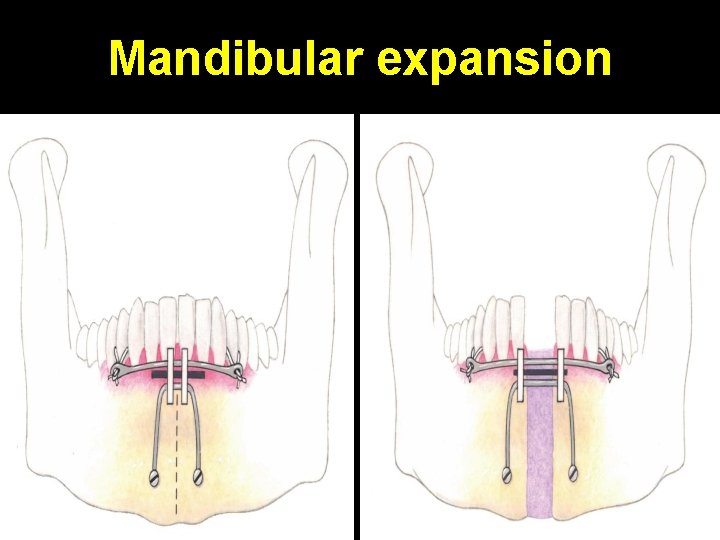 Mandibular expansion 