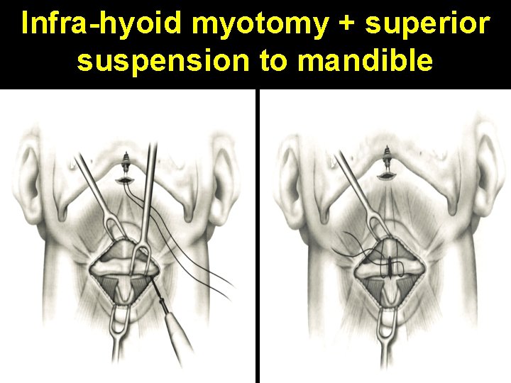 Infra-hyoid myotomy + superior suspension to mandible 