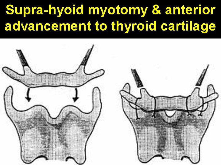Supra-hyoid myotomy & anterior advancement to thyroid cartilage 