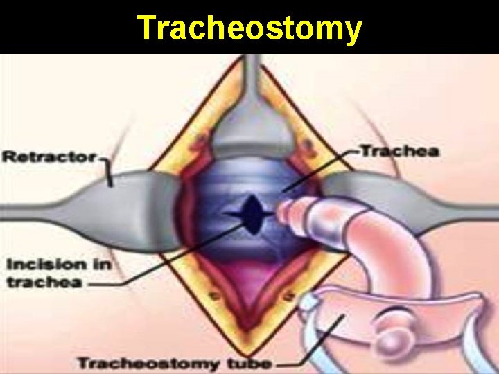 Tracheostomy 
