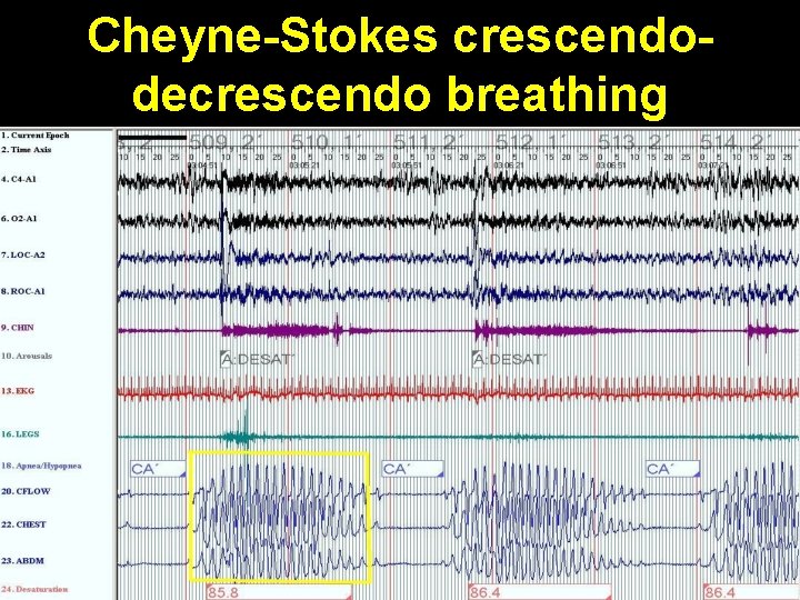 Cheyne-Stokes crescendodecrescendo breathing 