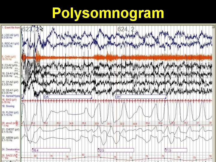 Polysomnogram 