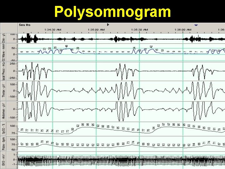 Polysomnogram 