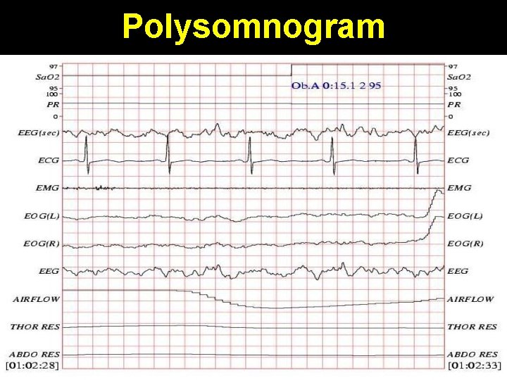 Polysomnogram 