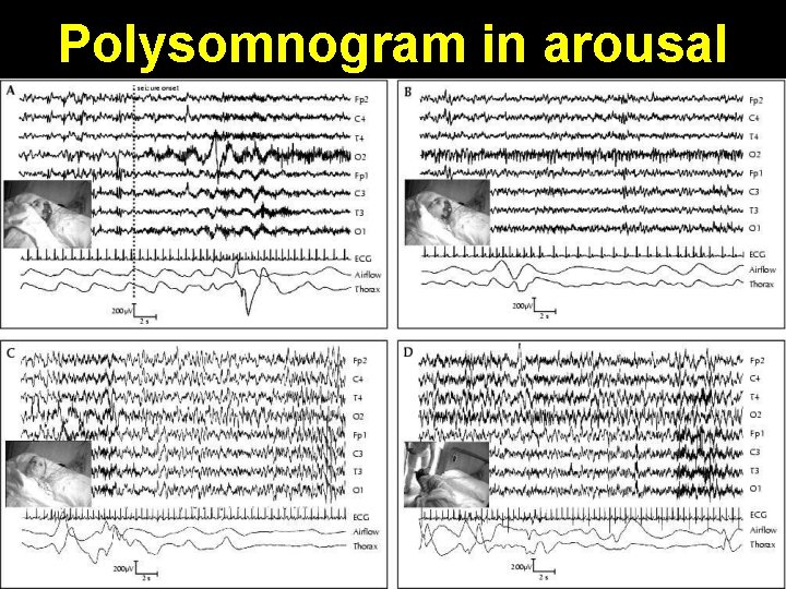 Polysomnogram in arousal 