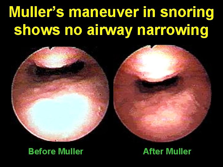 Muller’s maneuver in snoring shows no airway narrowing Before Muller After Muller 