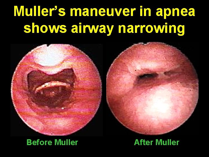 Muller’s maneuver in apnea shows airway narrowing Before Muller After Muller 