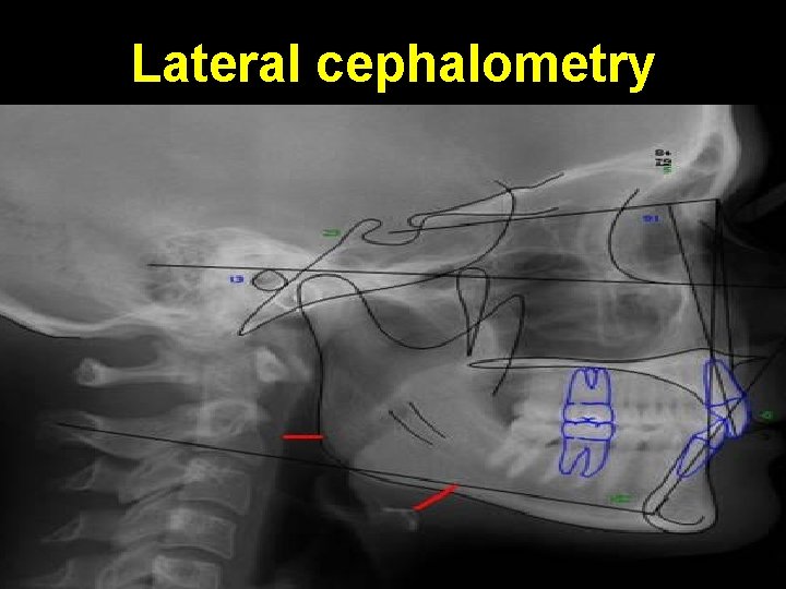 Lateral cephalometry 