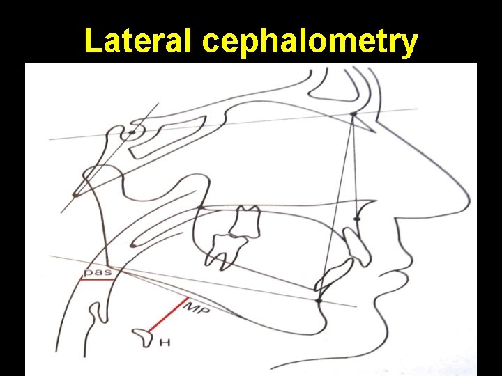 Lateral cephalometry 