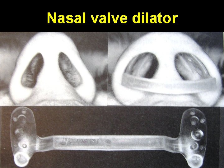 Nasal valve dilator 