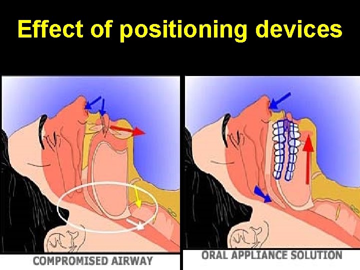 Effect of positioning devices 