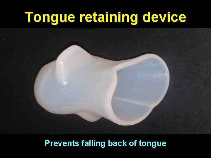 Tongue retaining device Prevents falling back of tongue 