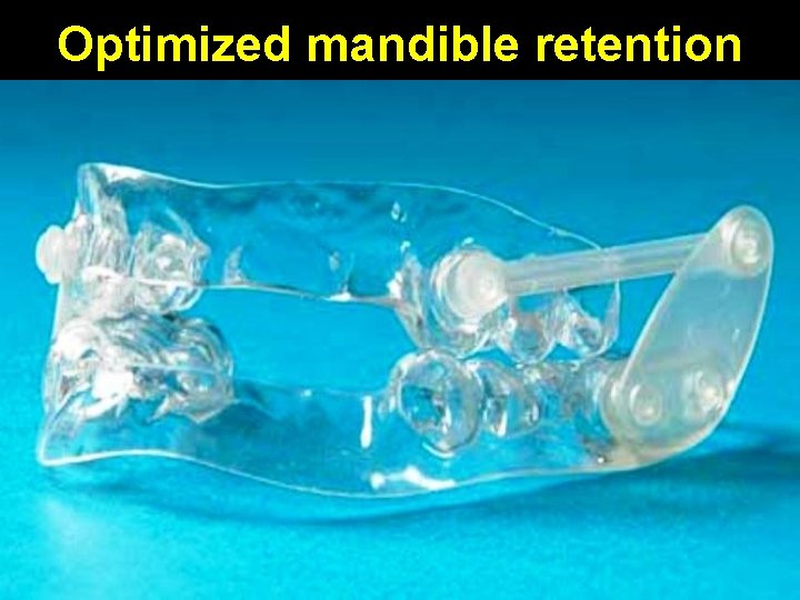 Optimized mandible retention 