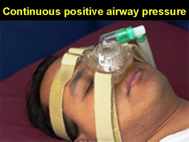 Continuous positive airway pressure 