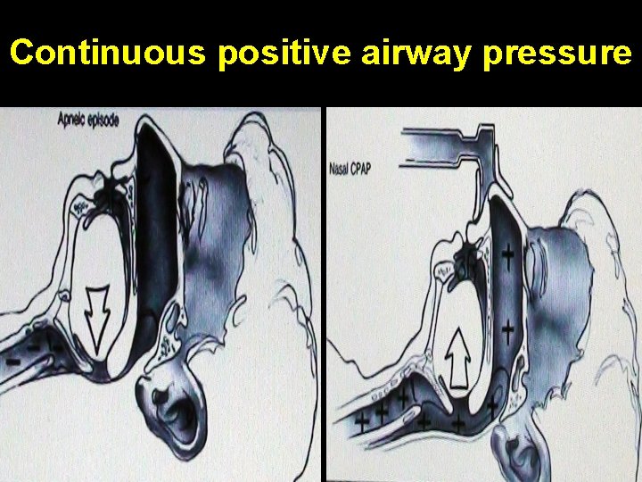 Continuous positive airway pressure 