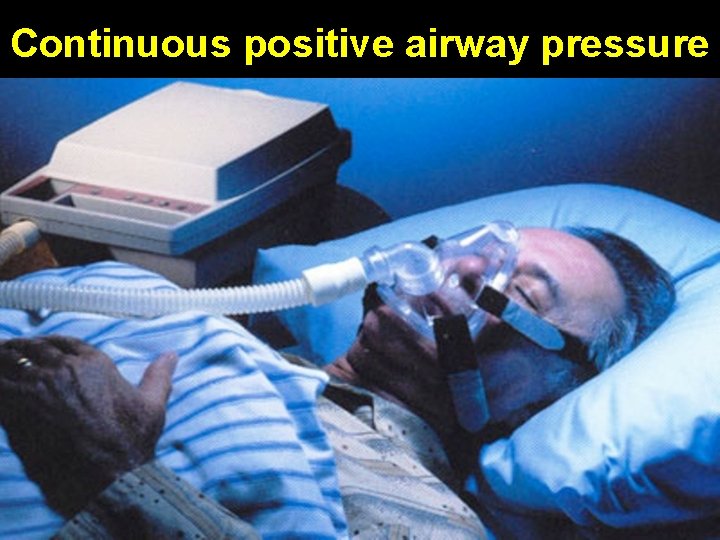 Continuous positive airway pressure 